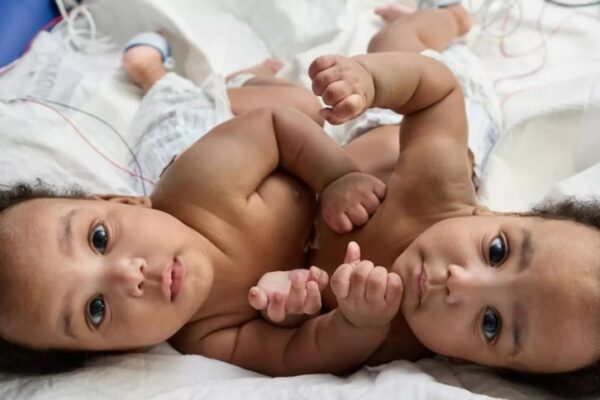 Tras casi un año los gemelos siameses fueron separados Tras casi un año los gemelos siameses fueron separados