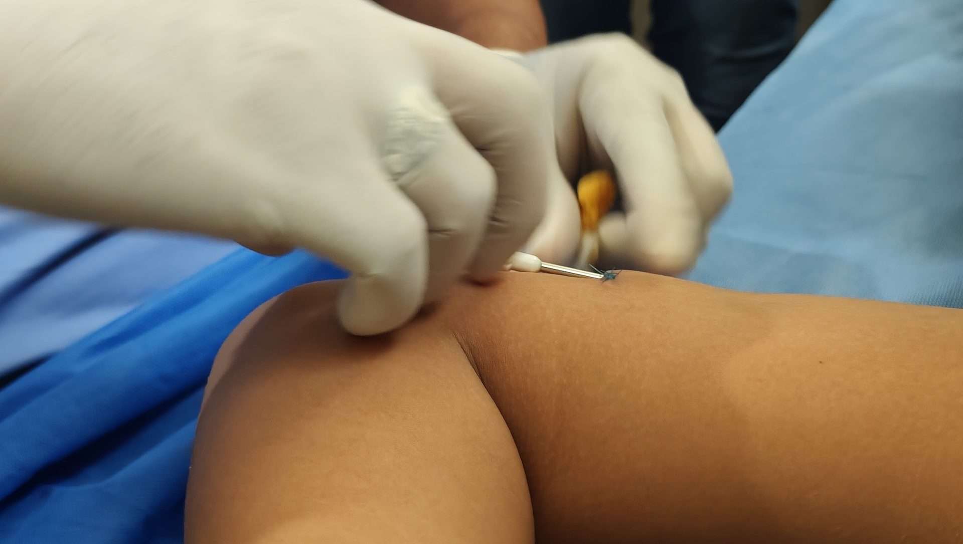 130 jóvenes reciben implantes anticonceptivos gratuitos en La Guaira